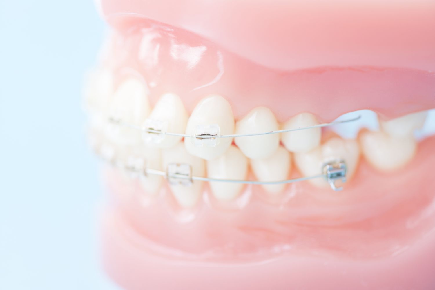 歯の矯正治療のメリット