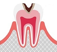 象牙質まで達している虫歯
